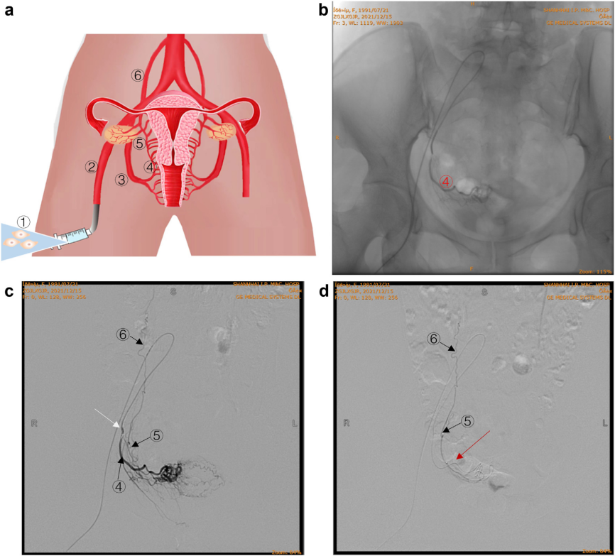 經卵巢動脈精準輸注hAEC