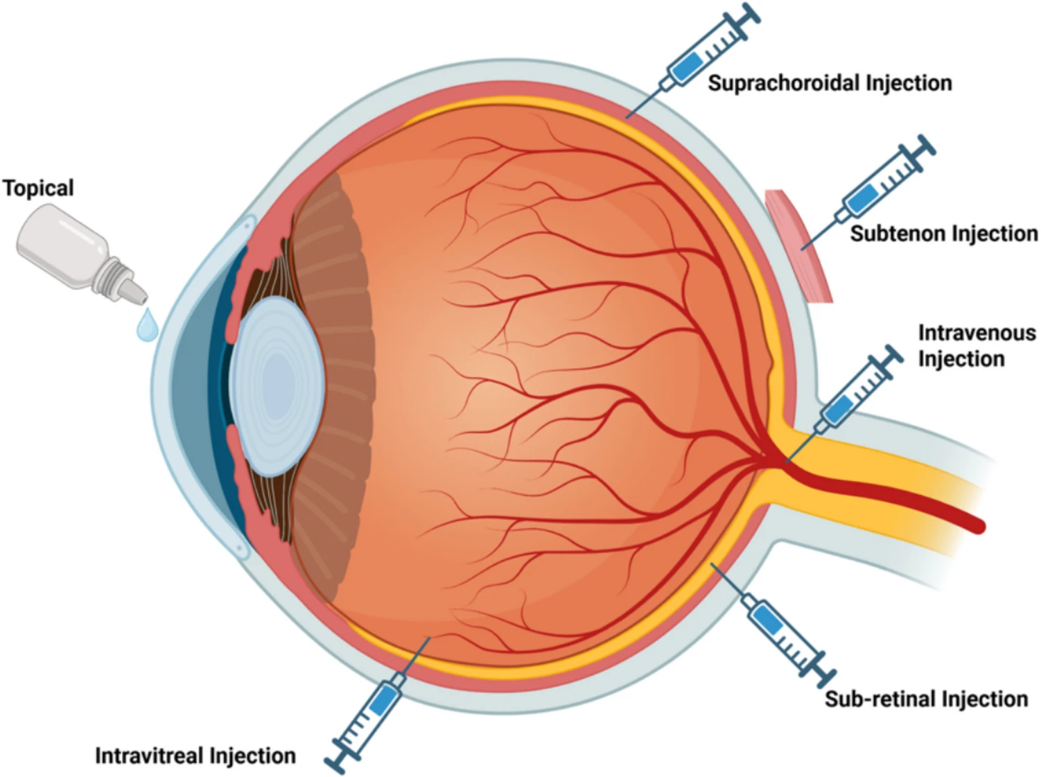 圖2：眼部基因和干細(xì)胞治療的給藥途徑