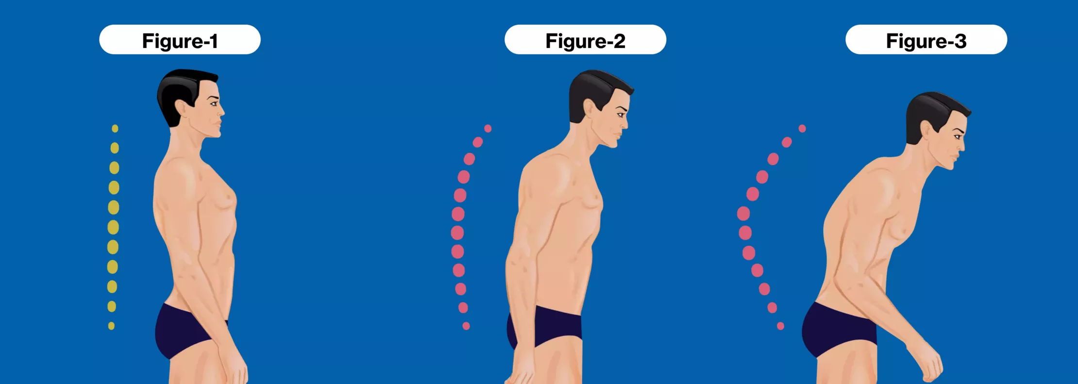 2025強(qiáng)直性脊柱炎治療指南:5種最新治療方法的臨床突破 2025強(qiáng)直性脊柱炎治療指南:5種最新治療方法的臨床突破