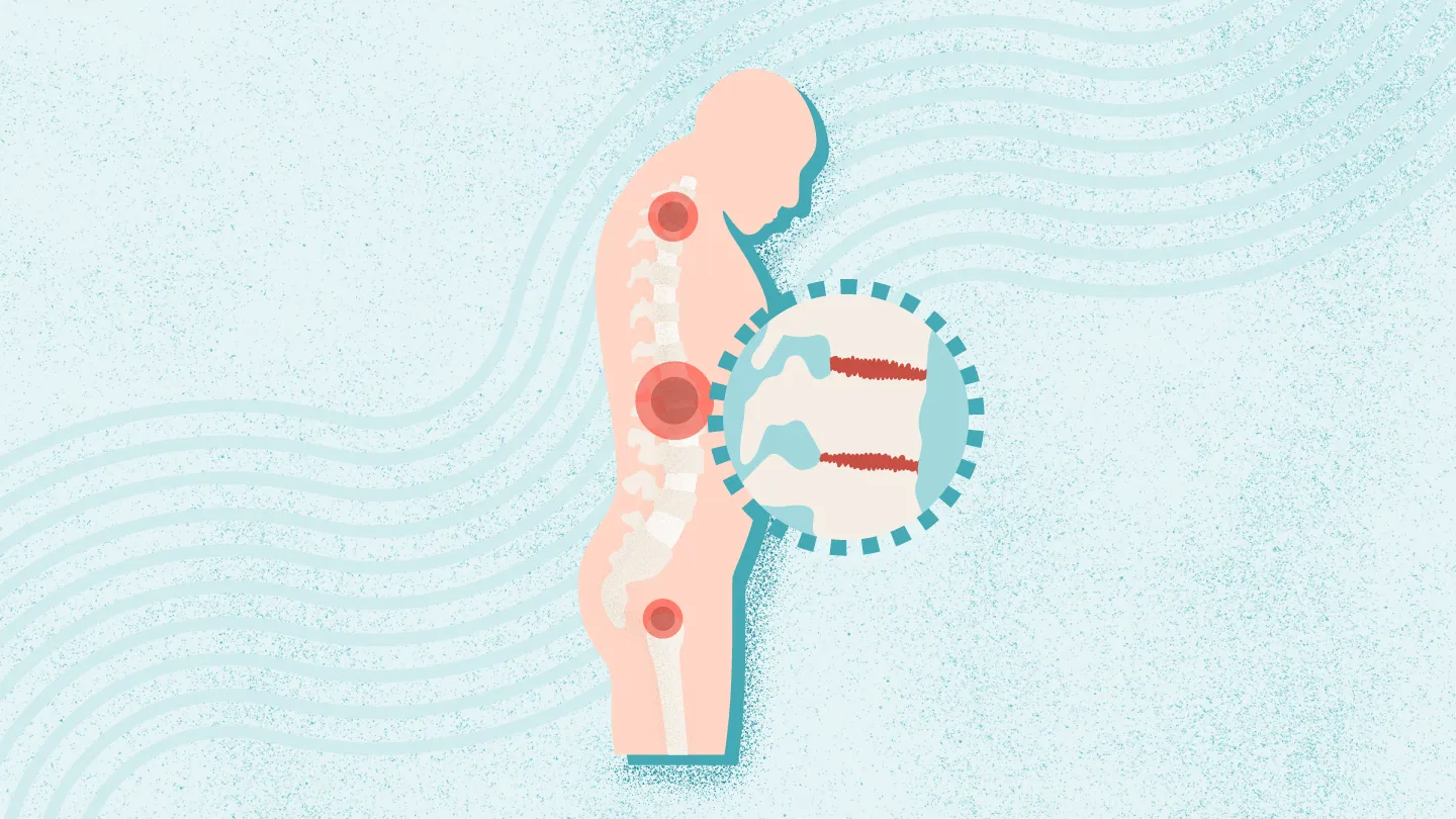 2025年干細胞治療強直性脊柱炎最新臨床進展（截至8月）