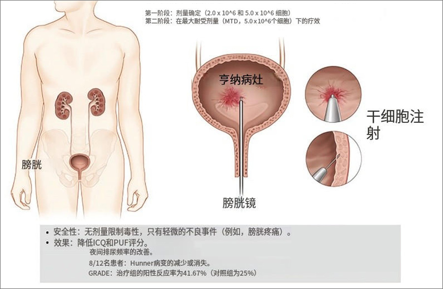 干細(xì)胞治療
