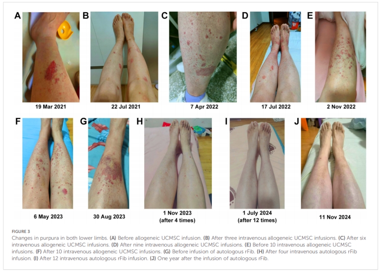 干燥綜合征臨床試驗 干燥綜合征臨床試驗