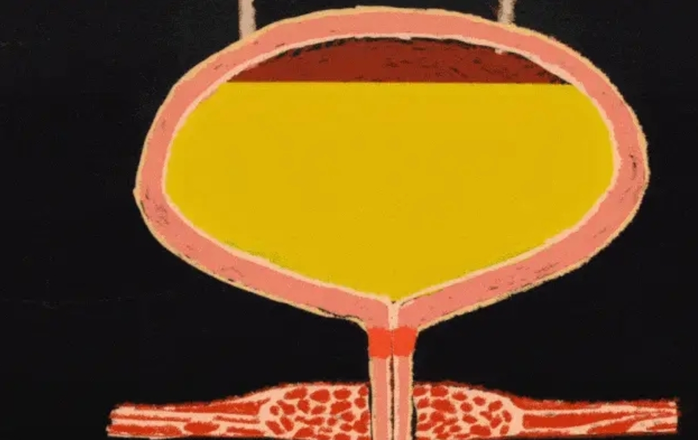 神經(jīng)源性膀胱 神經(jīng)源性膀胱