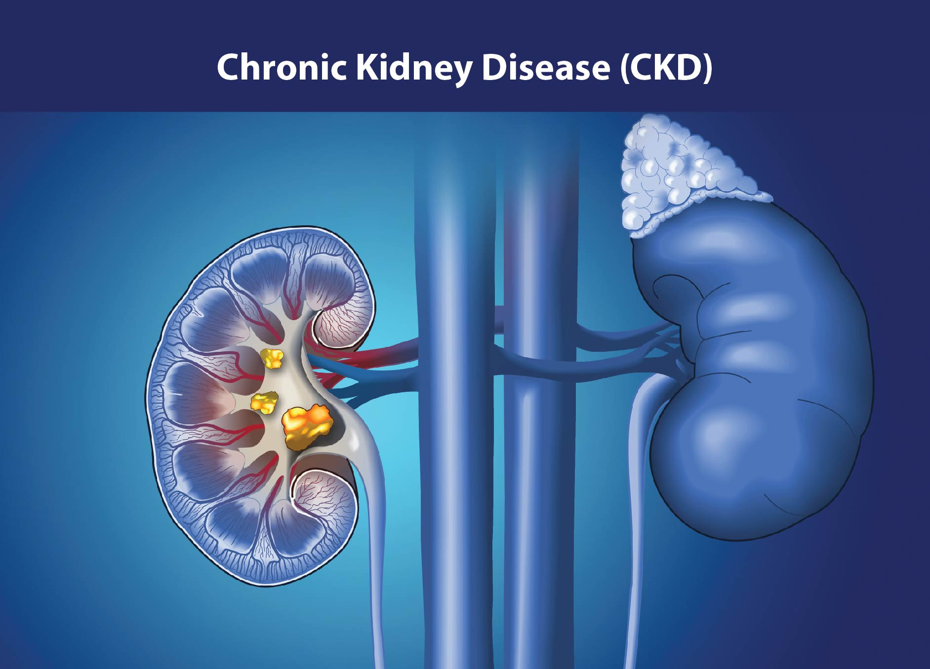 慢性腎病治療新策略：間充質(zhì)干細(xì)胞如何修復(fù)腎功能、延緩疾病進(jìn)展？