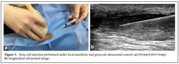 圖3.在局部麻醉和灰階超聲控制下進行的干細胞注射 圖3.在局部麻醉和灰階超聲控制下進行的干細胞注射