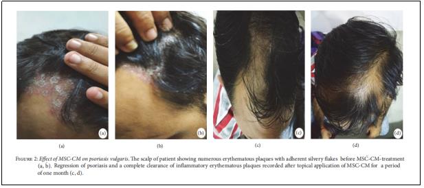 圖2：MSC-CM對尋常型銀屑病的影響。