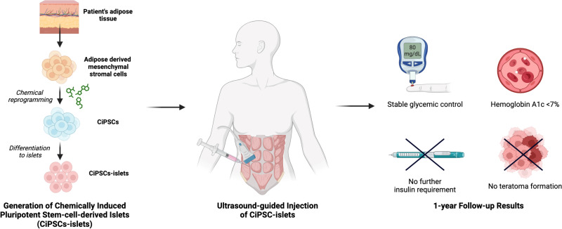 圖示:?通過將患者脂肪組織提取的間充質干細胞化學重編程為誘導多能干細胞并分化為胰島,再注射入腹直肌前鞘。 圖示:?通過將患者脂肪組織提取的間充質干細胞化學重編程為誘導多能干細胞并分化為胰島,再注射入腹直肌前鞘。