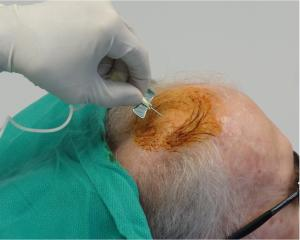 干細胞注射到大腦過程。